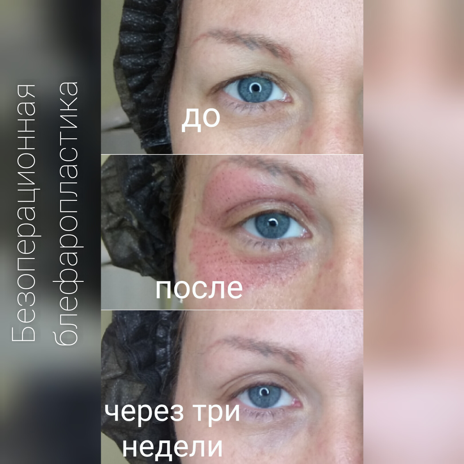 безоперационная блефаропластика люберцы, программы омоложения, лифтинг люберцы