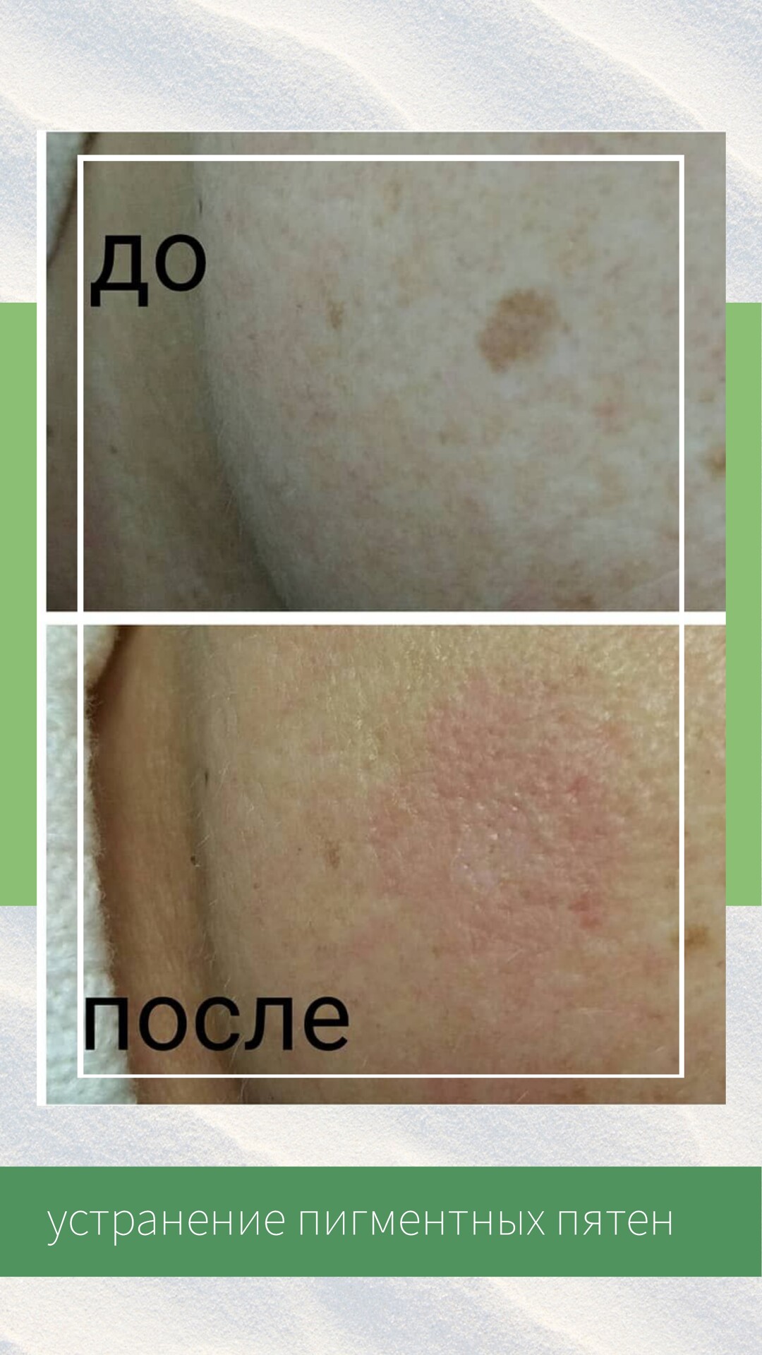 устранение пигментных пятен, гиперпигментация, возрастная пигментация, пилинг против пигментации, осветление лица